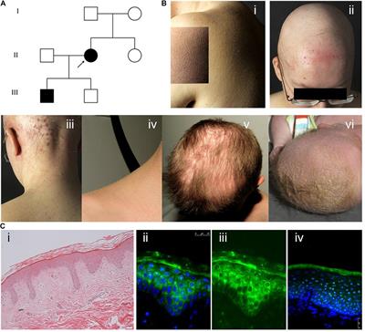 Cystatin M/E Variant Causes Autosomal Dominant Keratosis Follicularis Spinulosa Decalvans by Dysregulating Cathepsins L and V